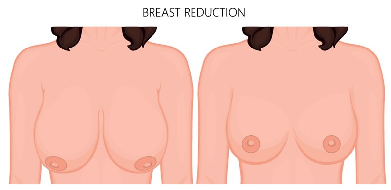 Breast Reduction in Turkey price