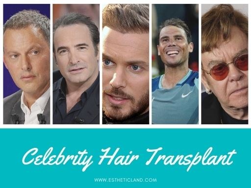 Celebrity's Hair Transplant – Estheticland