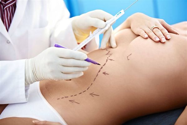 Liposuction Surgery Recovery